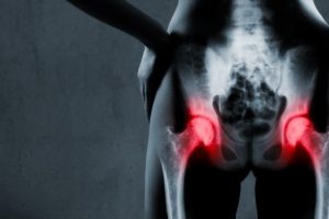 Alternatives To Hip Replacement Surgery Richmond
