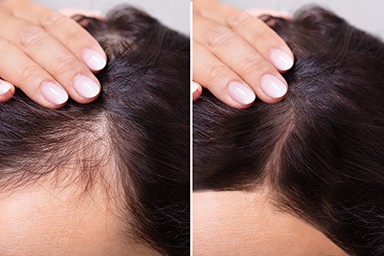 PRP for Hair Loss Richmond, VA