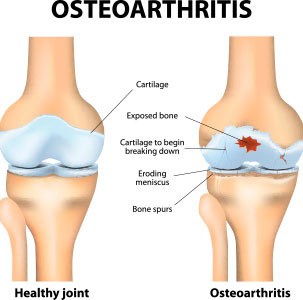 Regenerative Medicine Treatments for Severe Osteoarthritis Richmond, VA