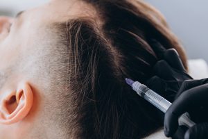 Unlocking Hair Restoration: A Deep Dive into PRP Microneedling at Regenerate Richmond