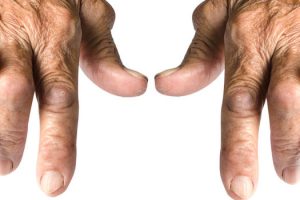 What Are The Early Signs of Arthritis Richmond, Virginia