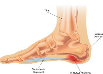 What is Plantar Fasciitis? Richmond, VA