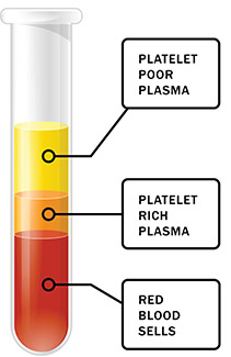 What is PRP Therapy? Richmond